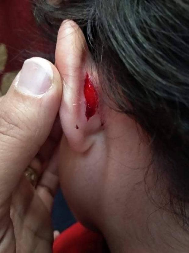 هن بالصور قطع في أذنه و4 غرز تفاصيل إصابة طفل بـ Kg2 بسبب مشرفة